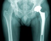 X-ray of prosthetic left femur